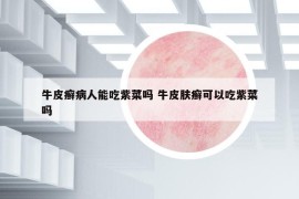 牛皮癬病人能吃紫菜嗎 牛皮膚癬可以吃紫菜嗎