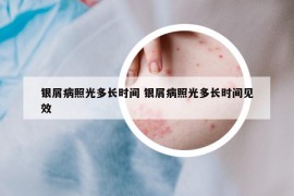 銀屑病照光多長時間 銀屑病照光多長時間見效