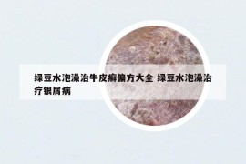 綠豆水泡澡治牛皮癬偏方大全 綠豆水泡澡治療銀屑病