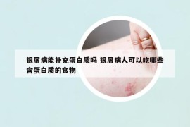 銀屑病能補(bǔ)充蛋白質(zhì)嗎 銀屑病人可以吃哪些含蛋白質(zhì)的食物