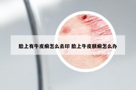 臉上有牛皮癬怎么去印 臉上牛皮膚癬怎么辦