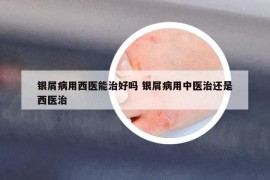 銀屑病用西醫(yī)能治好嗎 銀屑病用中醫(yī)治還是西醫(yī)治