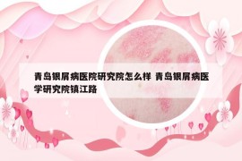 青島銀屑病醫(yī)院研究院怎么樣 青島銀屑病醫(yī)學研究院鎮(zhèn)江路