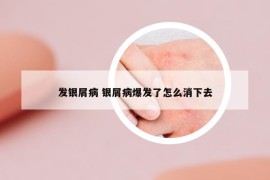 發(fā)銀屑病 銀屑病爆發(fā)了怎么消下去
