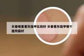長春哪里看灰指甲比較好 長春看灰指甲哪個醫(yī)院最好