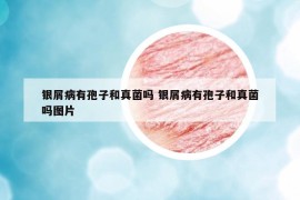 銀屑病有孢子和真菌嗎 銀屑病有孢子和真菌嗎圖片
