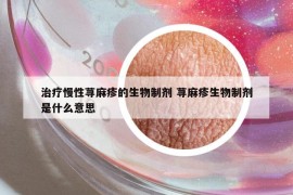治療慢性蕁麻疹的生物制劑 蕁麻疹生物制劑是什么意思