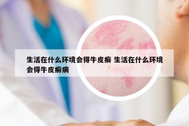 生活在什么環(huán)境會得牛皮癬 生活在什么環(huán)境會得牛皮癬病