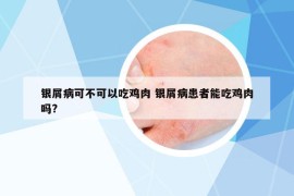 銀屑病可不可以吃雞肉 銀屑病患者能吃雞肉嗎?