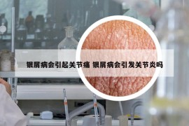 銀屑病會(huì)引起關(guān)節(jié)痛 銀屑病會(huì)引發(fā)關(guān)節(jié)炎嗎
