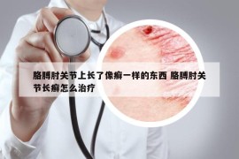 胳膊肘關(guān)節(jié)上長了像癬一樣的東西 胳膊肘關(guān)節(jié)長癬怎么治療