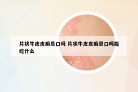 片狀牛皮皮癬忌口嗎 片狀牛皮皮癬忌口嗎能吃什么