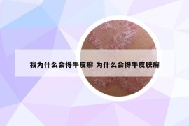 我為什么會(huì)得牛皮癬 為什么會(huì)得牛皮膚癬