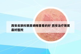 西安皮膚科銀屑病哪里看的好 西安治療銀屑最好醫(yī)院