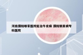 河南濮陽(yáng)哪家醫(yī)院能治牛皮癬 濮陽(yáng)銀屑病專(zhuān)科醫(yī)院