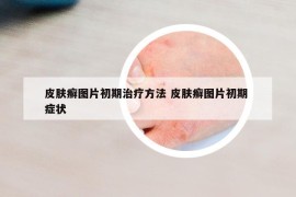 皮膚癬圖片初期治療方法 皮膚癬圖片初期 癥狀