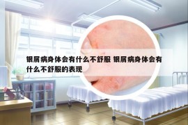 銀屑病身體會(huì)有什么不舒服 銀屑病身體會(huì)有什么不舒服的表現(xiàn)