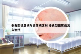 非典型銀屑病與銀屑病區(qū)別 非典型銀屑病怎么治療