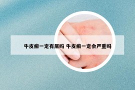 牛皮癬一定有屑嗎 牛皮癬一定會嚴(yán)重嗎