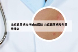 北京銀屑病治療好的醫(yī)院 北京銀屑病?？漆t(yī)院排名