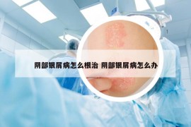 陰部銀屑病怎么根治 陰部銀屑病怎么辦
