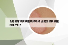 合肥哪家銀屑病醫(yī)院好不好 合肥治銀屑病醫(yī)院哪個好?