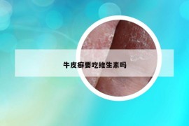 牛皮癬要吃維生素嗎