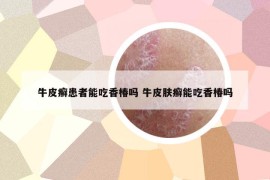 牛皮癬患者能吃香椿嗎 牛皮膚癬能吃香椿嗎