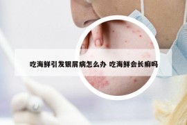 吃海鮮引發(fā)銀屑病怎么辦 吃海鮮會長癬嗎