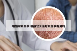 硼酸對銀屑病 硼酸軟膏治療銀屑病有用嗎