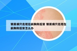 銀屑病只出現(xiàn)在前胸和后背 銀屑病只出現(xiàn)在前胸和后背怎么辦