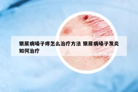 銀屑病嗓子疼怎么治療方法 銀屑病嗓子發(fā)炎如何治療