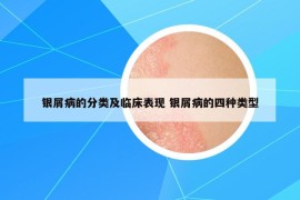 銀屑病的分類及臨床表現(xiàn) 銀屑病的四種類型