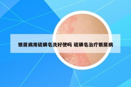銀屑病用硫磺皂洗好使嗎 硫磺皂治療銀屑病