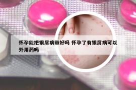 懷孕能把銀屑病帶好嗎 懷孕了有銀屑病可以外用藥嗎