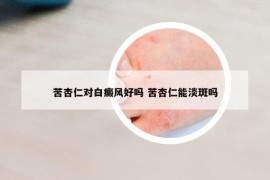 苦杏仁對白癜風(fēng)好嗎 苦杏仁能淡斑嗎