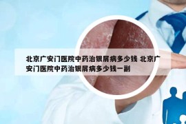 北京廣安門醫(yī)院中藥治銀屑病多少錢 北京廣安門醫(yī)院中藥治銀屑病多少錢一副