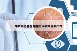 牛皮癬患者在海南住 海南牛皮癬療養(yǎng)