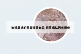 治銀屑病的貼膏哪里有賣 銀屑病貼藥有哪些