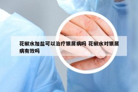 花椒水加鹽可以治療銀屑病嗎 花椒水對(duì)銀屑病有效嗎