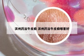 濱州藥浴牛皮癬 濱州藥浴牛皮癬哪里好