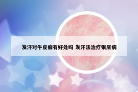 發(fā)汗對牛皮癬有好處嗎 發(fā)汗法治療銀屑病