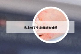 頭上長了牛皮癬能治好嗎