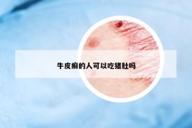 牛皮癬的人可以吃豬肚嗎