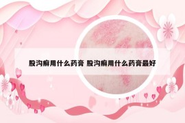 股溝癬用什么藥膏 股溝癬用什么藥膏最好