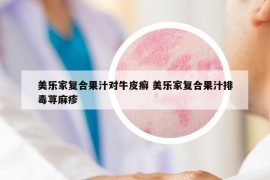 美樂家復(fù)合果汁對(duì)牛皮癬 美樂家復(fù)合果汁排毒蕁麻疹