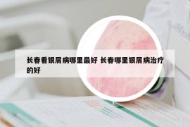 長(zhǎng)春看銀屑病哪里最好 長(zhǎng)春哪里銀屑病治療的好