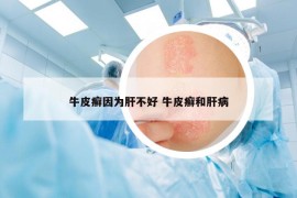牛皮癬因?yàn)楦尾缓?牛皮癬和肝病