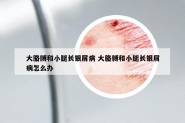 大胳膊和小腿長銀屑病 大胳膊和小腿長銀屑病怎么辦