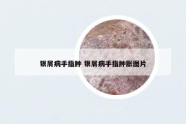 銀屑病手指腫 銀屑病手指腫脹圖片